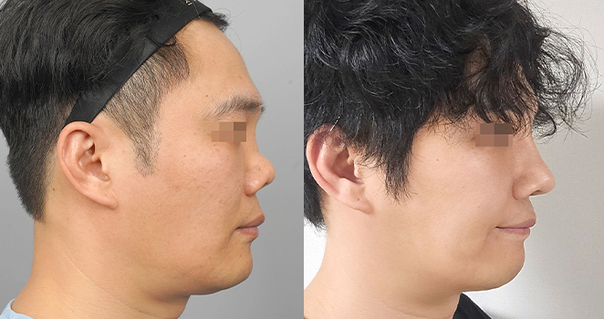 코재수술(re)+자가늑연골