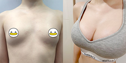 가슴확대(세빈) 300cc