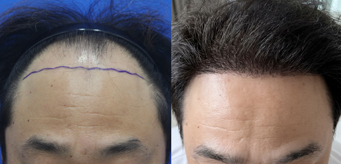 남성모발이식(헤어라인+정수리 혼용 절개4000모+비절개2000모)