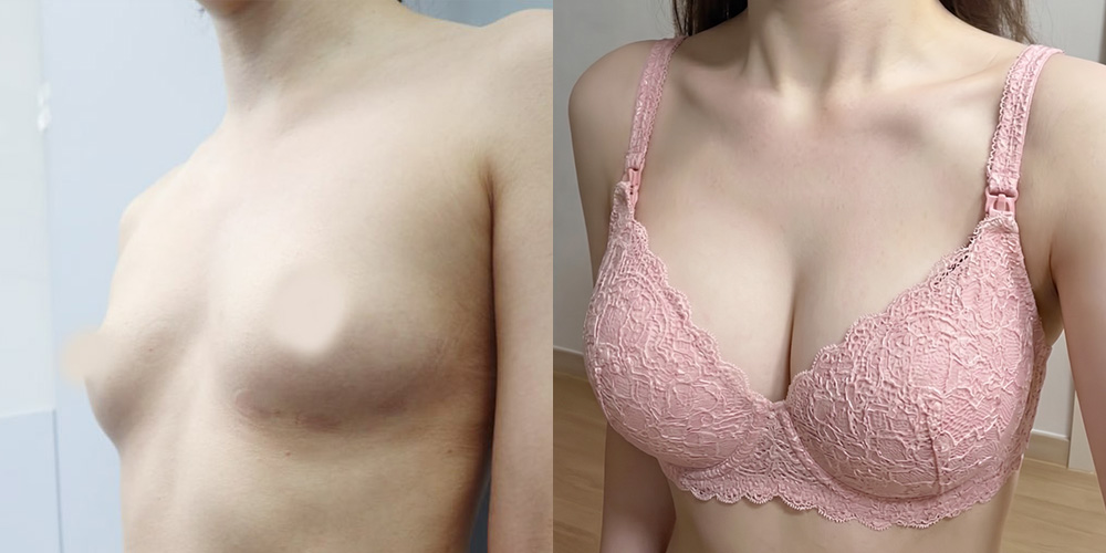 가슴확대(세빈)