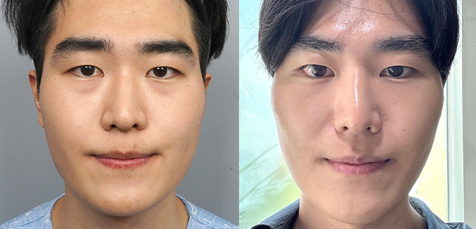 앙코르눈밑지