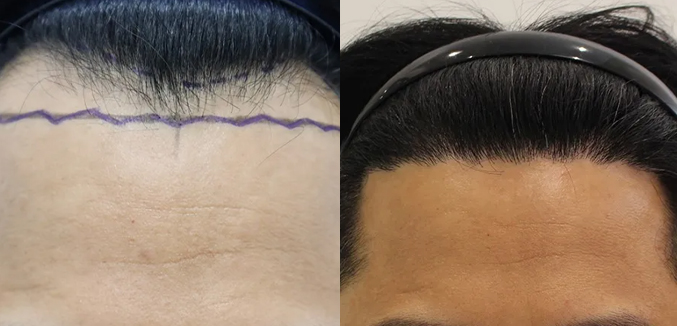 남성모발이식(비절개 헤어라인 3000모)