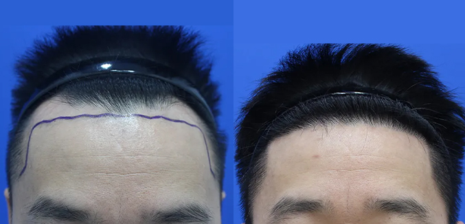 남성모발이식(헤어라인 절개 2600모)