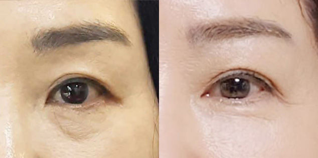 눈(상안검+하안검)