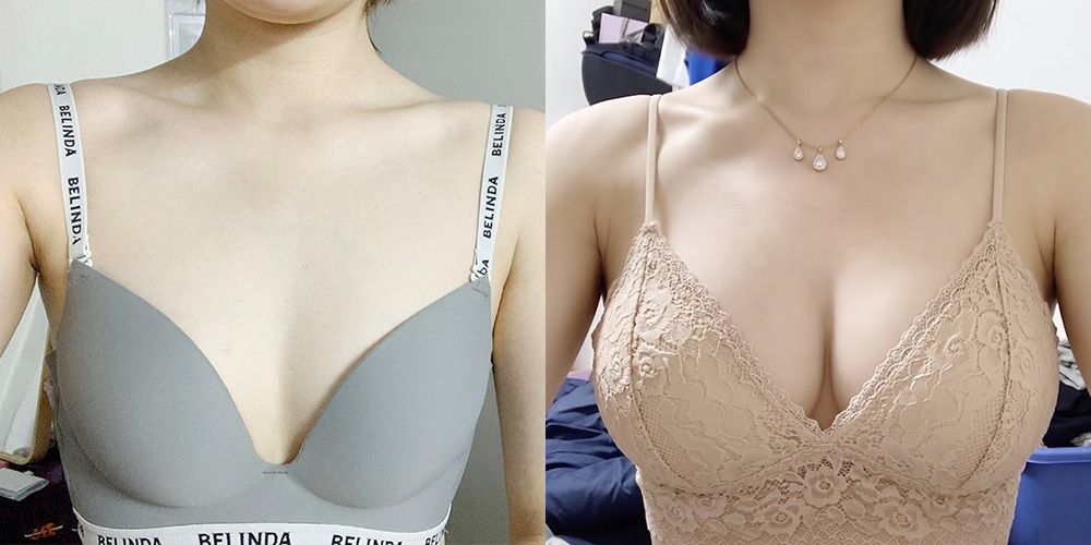 가슴확대(모티바)