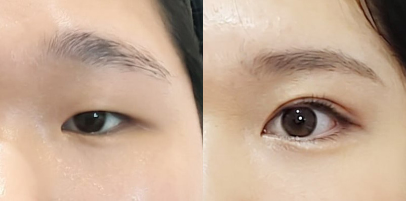 눈(절개눈매교정+앞트임+듀얼트임)