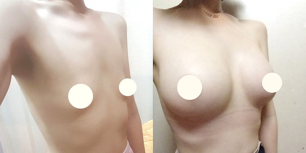 가슴확대(멘토라운드)