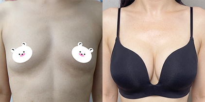 가슴확대(멘토엑스트라) 330cc