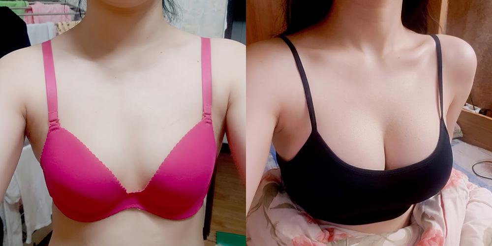 가슴확대(멘토클래식)