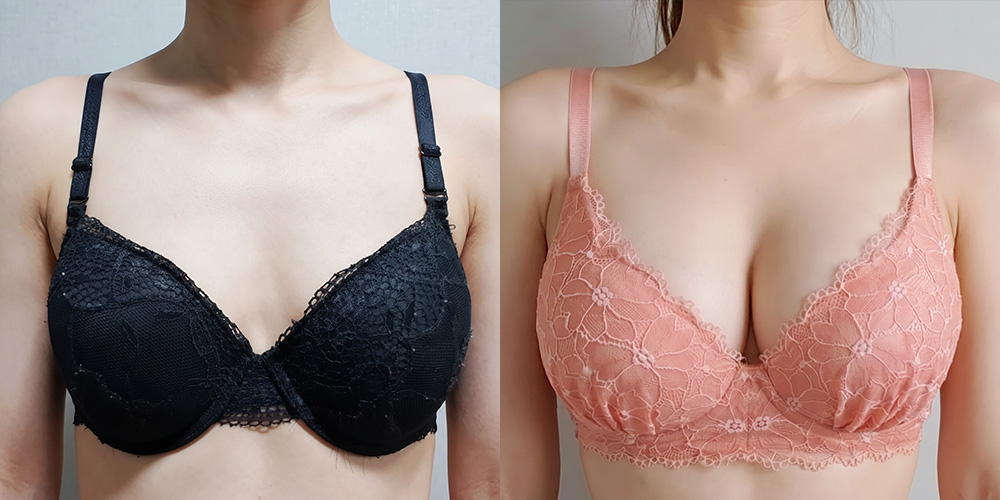 가슴확대(모티바)