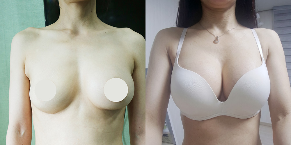 가슴재수술(모티바)
