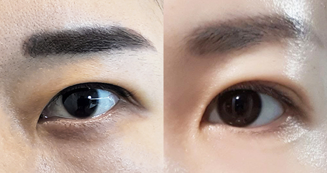 상안검 눈매교정+눈재수술