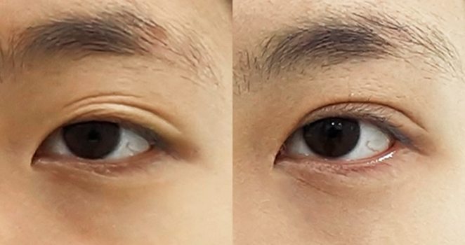 절개 눈매교정+듀얼트임
