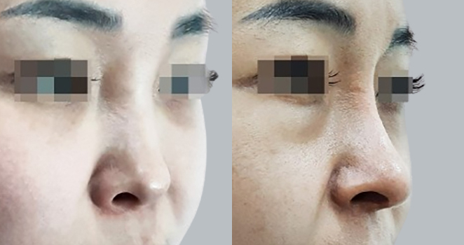 코재수술