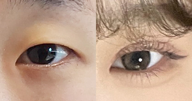 절개눈매교정+앞트임