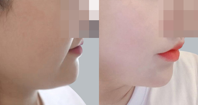 심부볼제거+리프팅