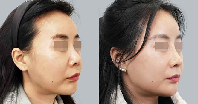 짧은코교정+자가늑연골 재수술