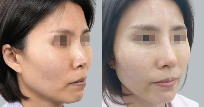 노플란트+자가늑연골 재수술