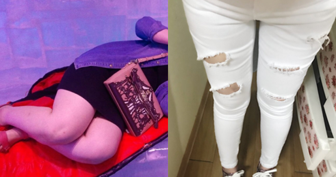 허벅지 지방흡입