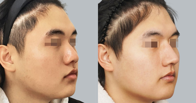 노플란트+자가늑연골