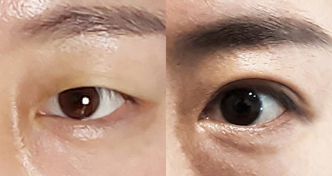 절개눈성형