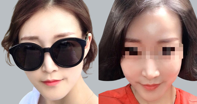 샤넬주사