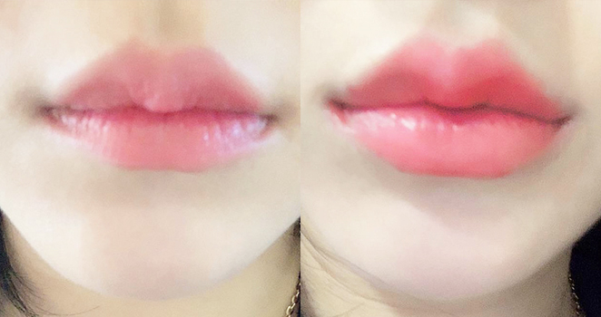 입술+입꼬리필러