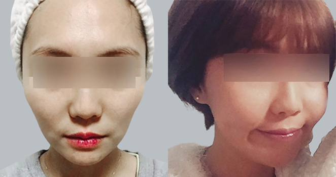 큐오필 필러