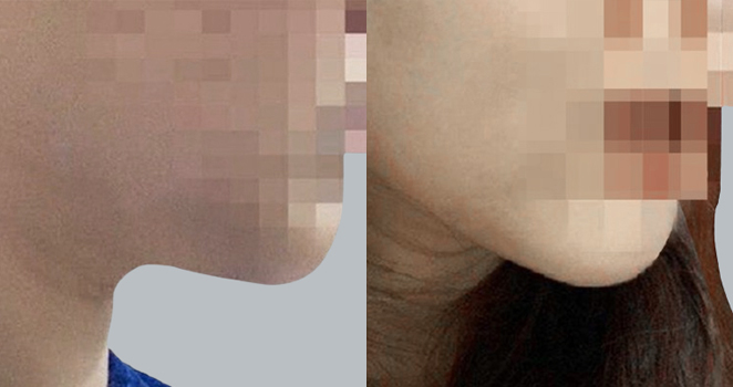 이중턱흡입+실리프팅