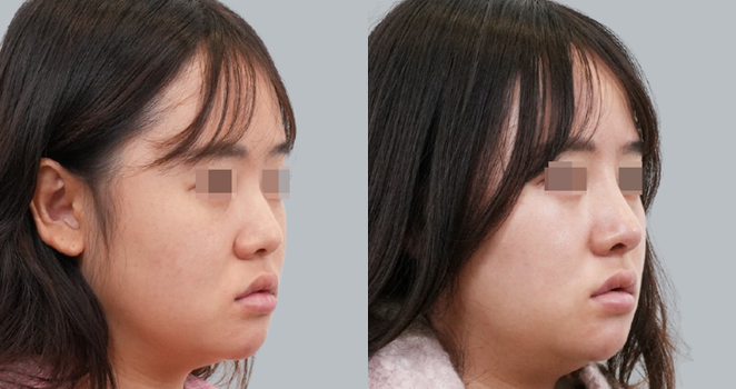 개방코성형+자가늑연골