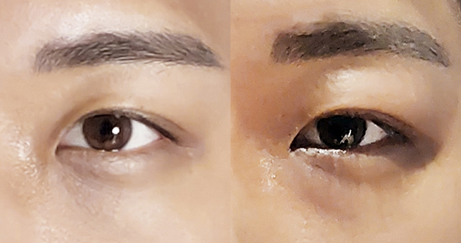 절개 눈매교정