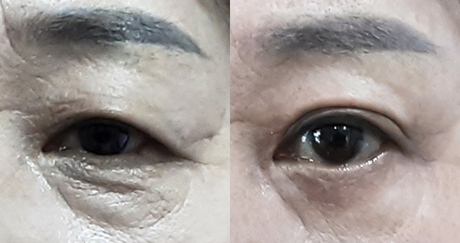 상안검+하안검