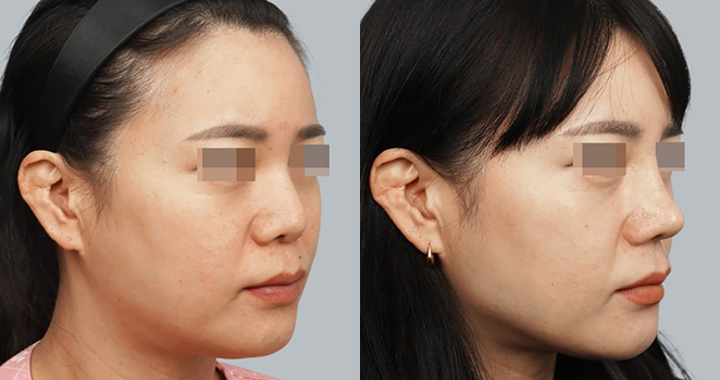 3D맞춤보형물+자가늑연골 재수술