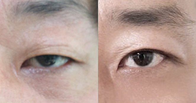 상안검