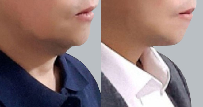 얼굴지방흡입+실리프팅