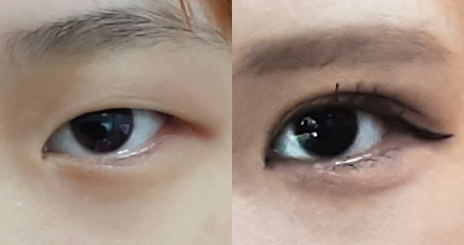 절개 눈성형+앞트임