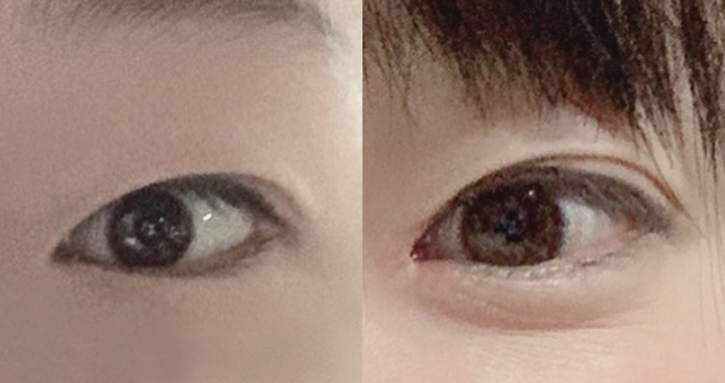 눈매교정+앞트임