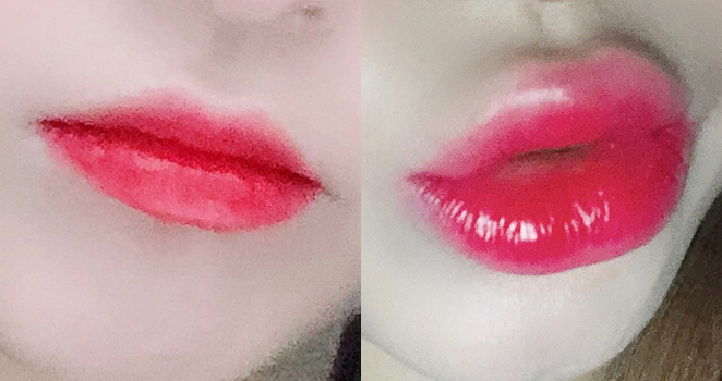 입술+입꼬리필러