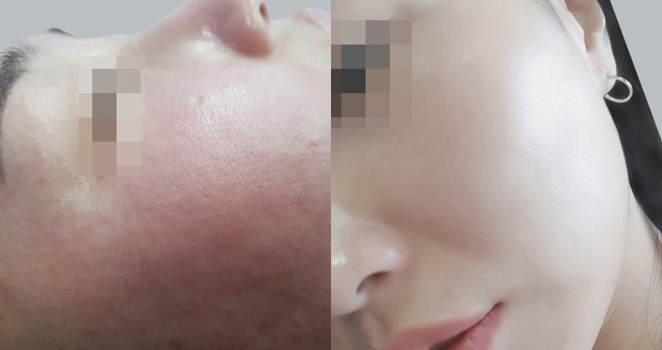 프락셀 레이저