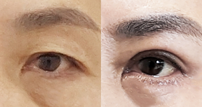 상안검+눈매교정