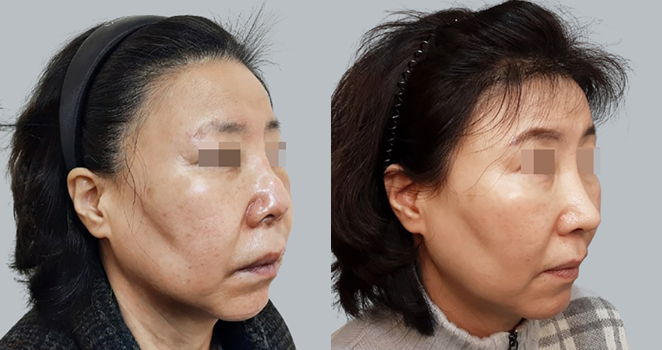 개방코성형+기증늑연골