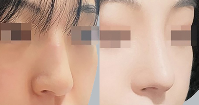 개방코성형