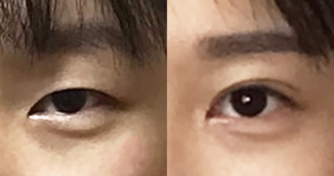 비절개 눈매교정+윗트임