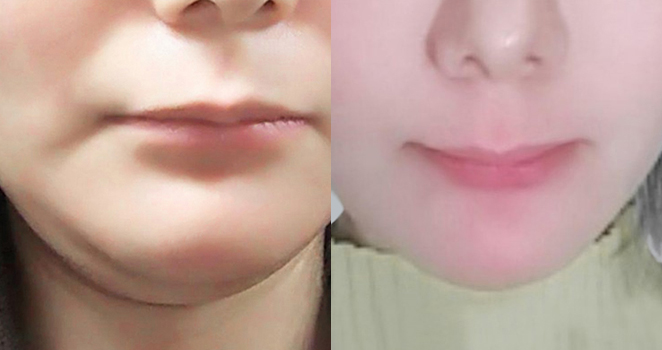 이중턱흡입+실리프팅