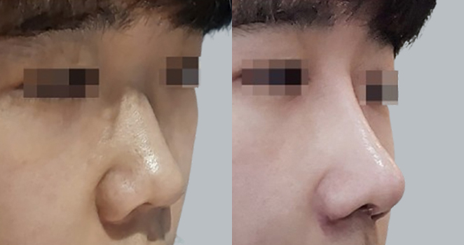개방코성형+콧볼축소