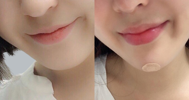 입술+입꼬리+턱끝필러