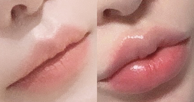 입술필러+입꼬리보톡스