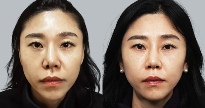 노플란트+자가늑연골 재수술