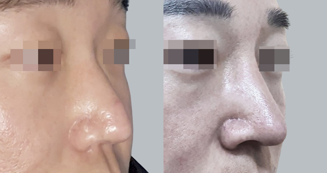 개방코성형+짧은코연장+매부리