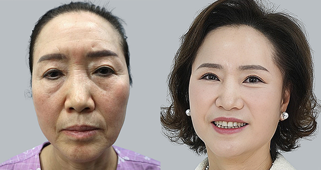 안면거상술